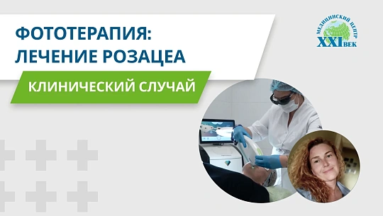 Лечение розацеа: помогла ли фототерапия?